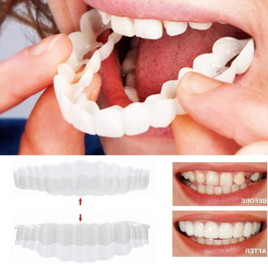 Full Dental Veneer Kit – Upper & Lower Cosmetic Covers
